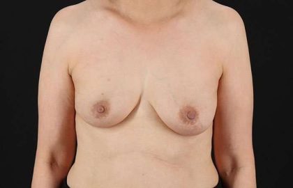 Implant Based Reconstruction Before & After Patient #3549