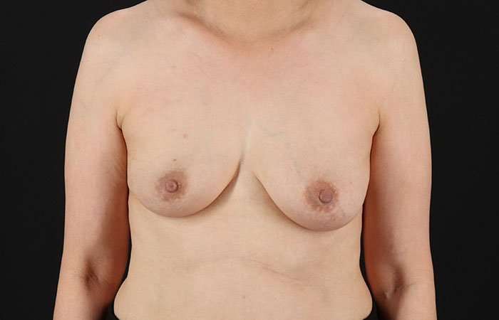 Implant Based Reconstruction Before & After Patient #3549