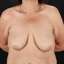 Breast Lift Before & After Patient #3571