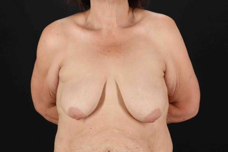 Breast Lift Before & After Patient #3571