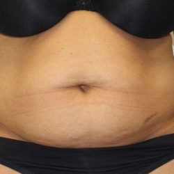 Abdominoplasty (Tummy Tuck) Before & After Patient #889