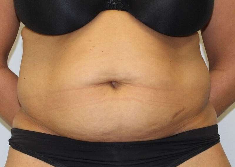 Abdominoplasty (Tummy Tuck) Before & After Patient #889