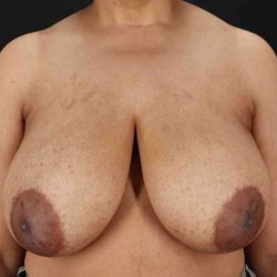 Breast Lift Before & After Patient #3626