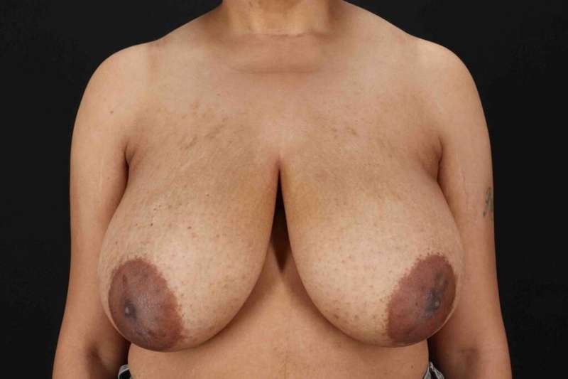 Breast Lift Before & After Patient #3626