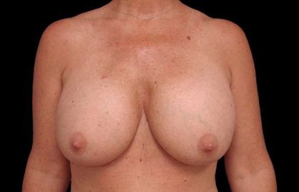 Breast Lift Before & After Patient #3633