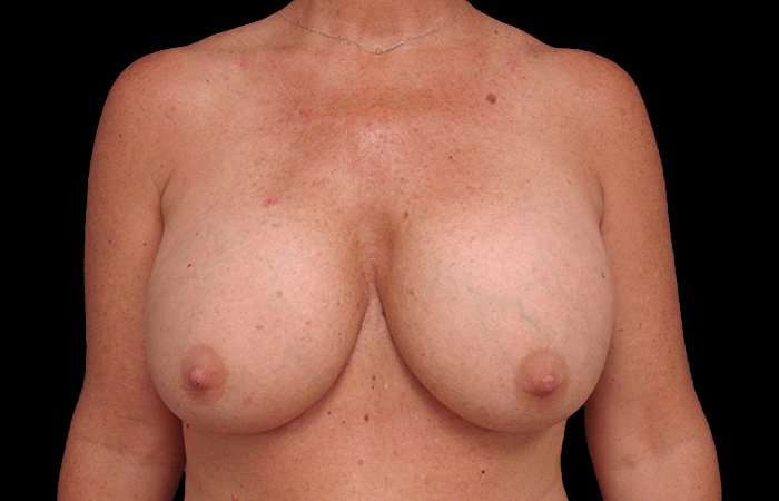 Breast Lift Before & After Patient #3633