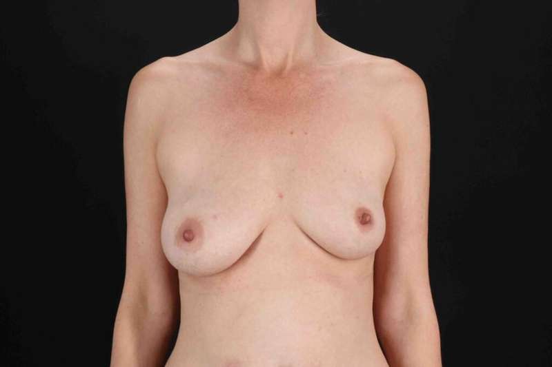 Breast Lift Before & After Patient #3673