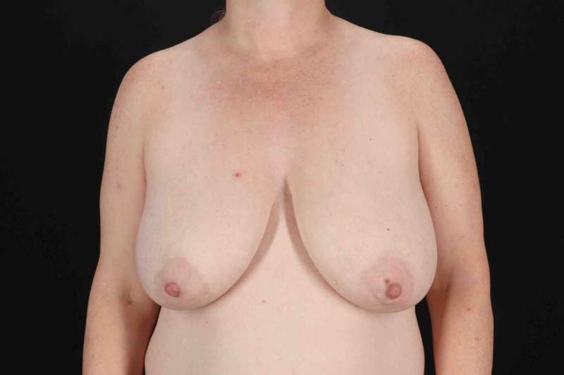 Breast Lift Before & After Patient #3684