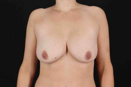 Breast Lift Before & After Patient #3695