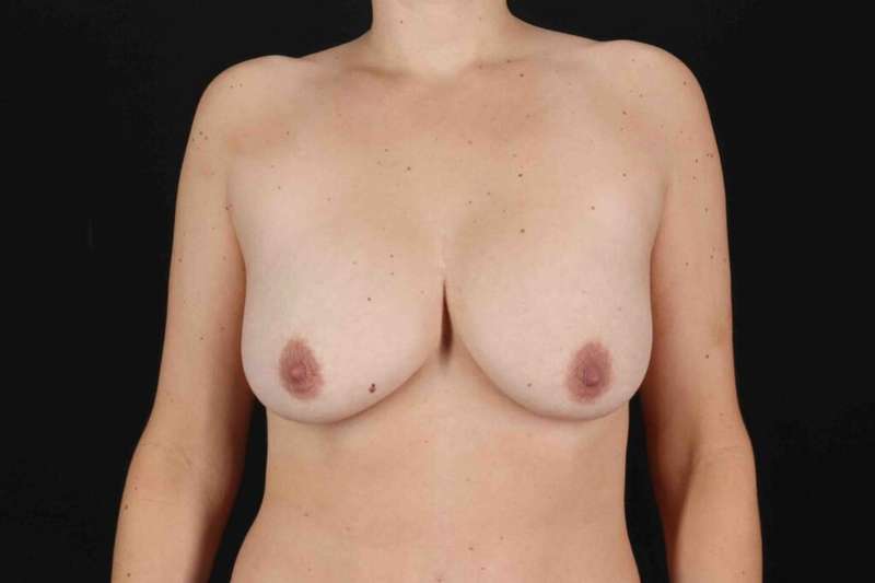 Breast Lift Before & After Patient #3695