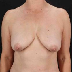 Breast Lift Before & After Patient #3706