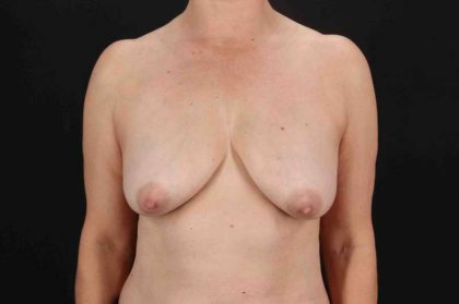 Breast Lift Before & After Patient #3706