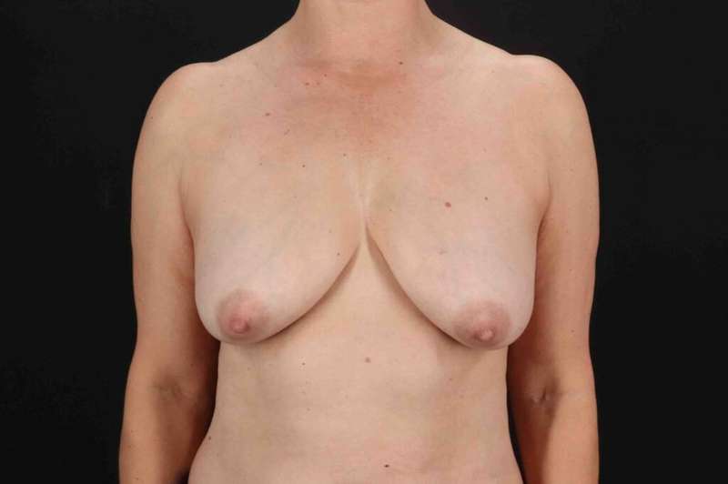 Breast Lift Before & After Patient #3706