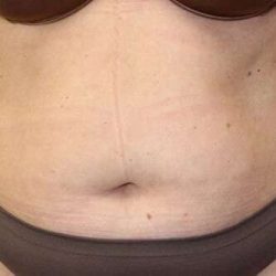 Abdominoplasty (Tummy Tuck) Before & After Patient #897