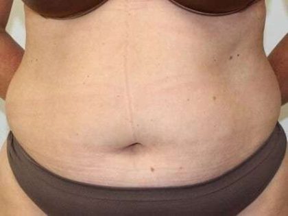 Abdominoplasty (Tummy Tuck) Before & After Patient #897