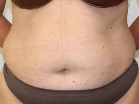 Abdominoplasty (Tummy Tuck) Before & After Patient #897