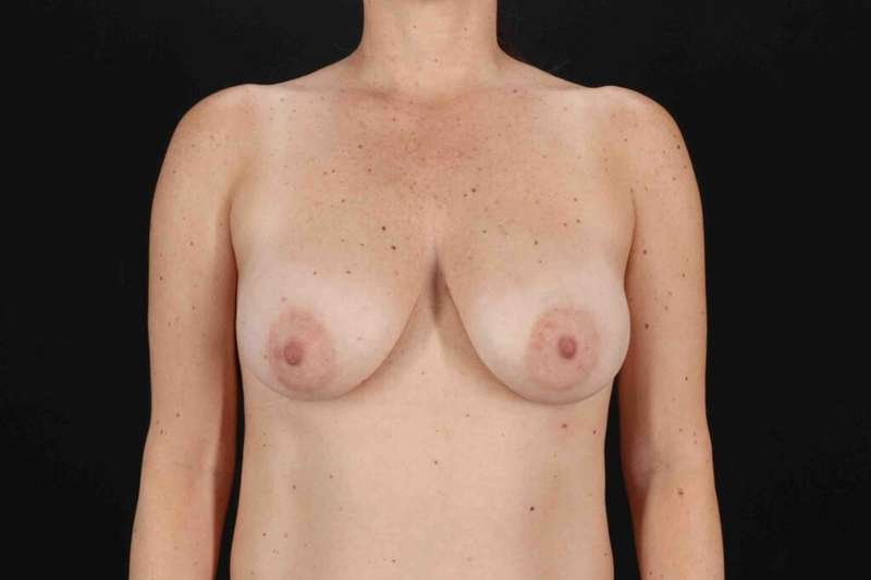 Breast Lift Before & After Patient #3728