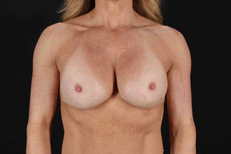 Breast Lift Before & After Patient #3739