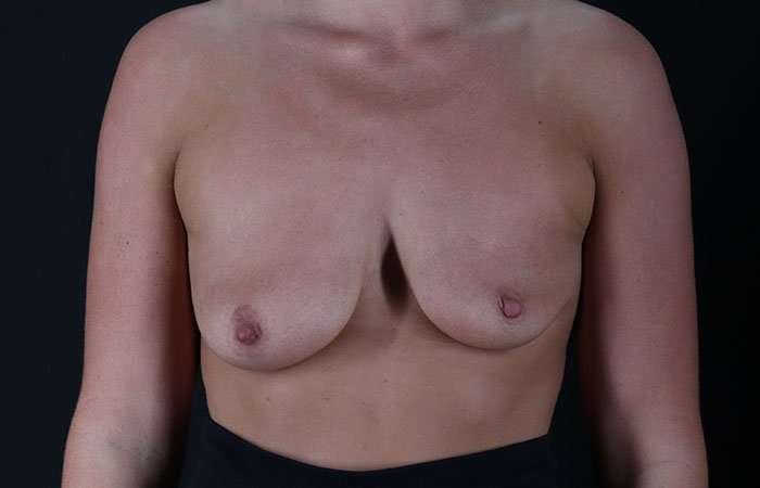Breast Lift Before & After Patient #3750