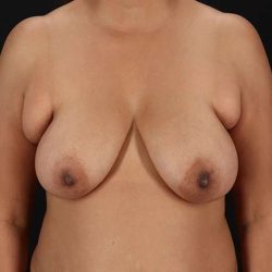 Breast Lift Before & After Patient #3840