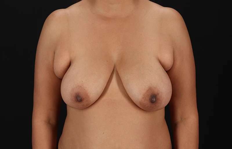 Breast Lift Before & After Patient #3840
