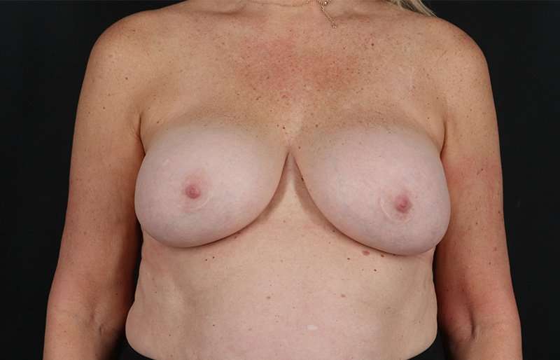 Breast Lift Before & After Patient #3864