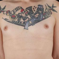 Male To Female Breast Before & After Patient #3886
