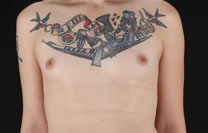 Male To Female Breast Before & After Patient #3886
