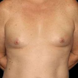 Male To Female Breast Before & After Patient #3893