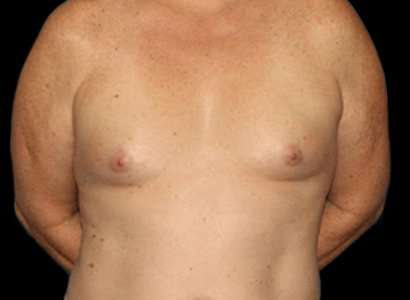 Male To Female Breast Before & After Patient #3893
