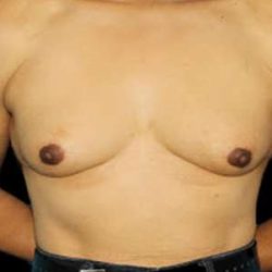 Male To Female Breast Before & After Patient #3900