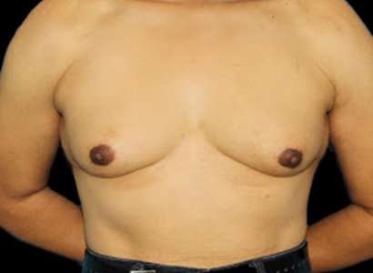 Male To Female Breast Before & After Patient #3900
