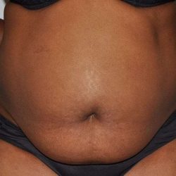 Abdominoplasty (Tummy Tuck) Before & After Patient #913
