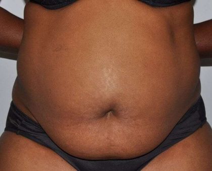 Abdominoplasty (Tummy Tuck) Before & After Patient #913