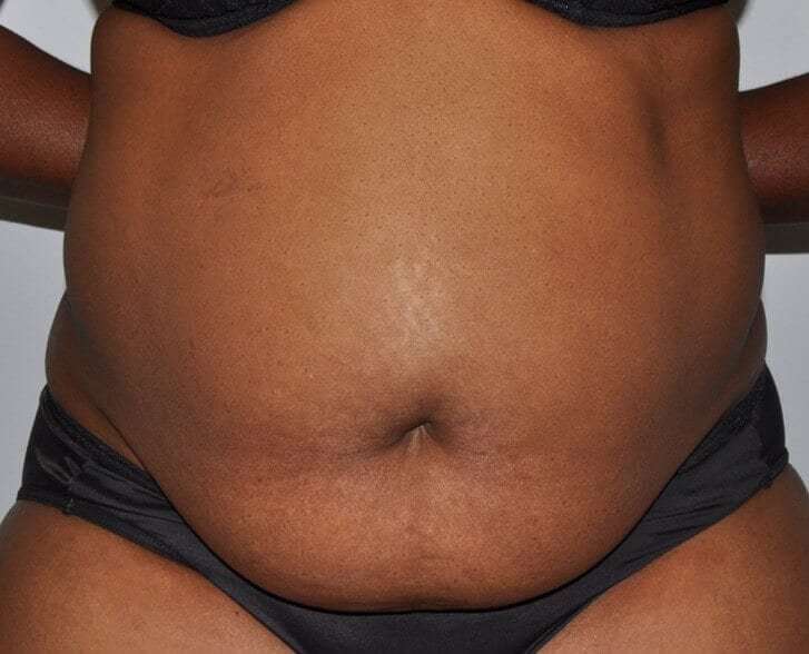 Abdominoplasty (Tummy Tuck) Before & After Patient #913