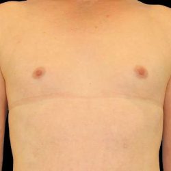 Male To Female Breast Before & After Patient #3911