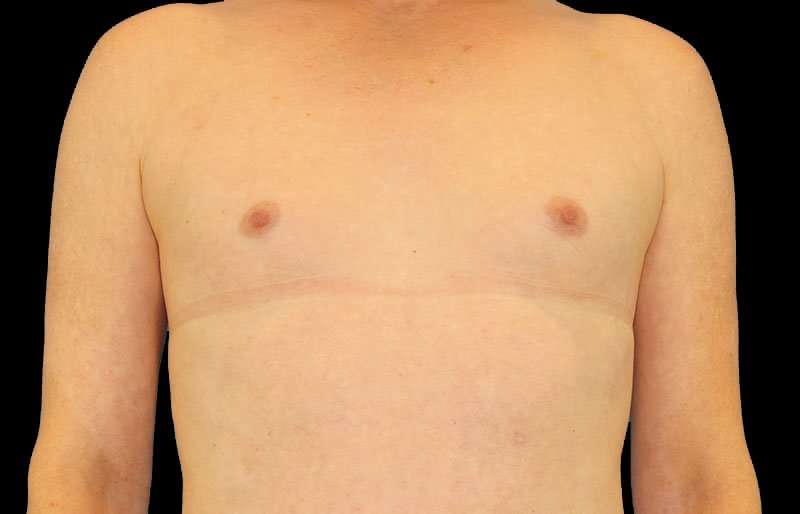 Male To Female Breast Before & After Patient #3911