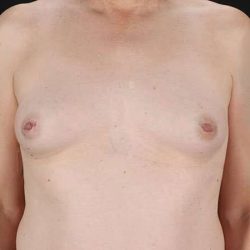 Male To Female Breast Before & After Patient #3922