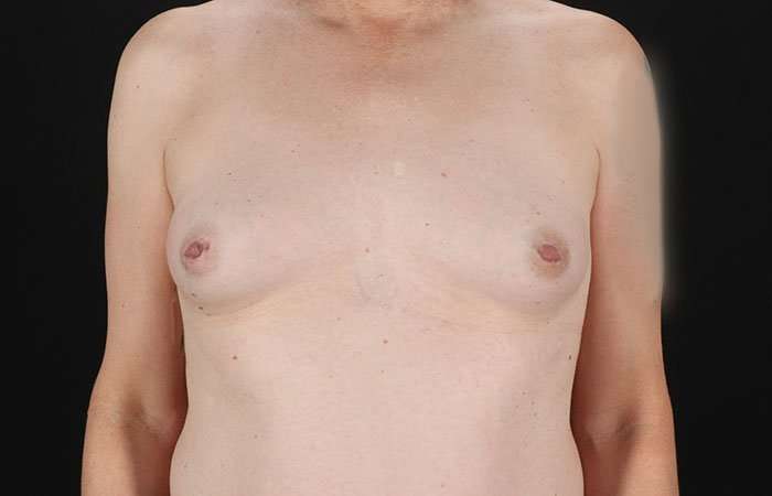 Male To Female Breast Before & After Patient #3922