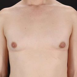 Male To Female Breast Before & After Patient #3933