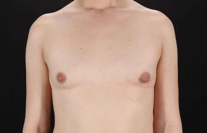 Male To Female Breast Before & After Patient #3933