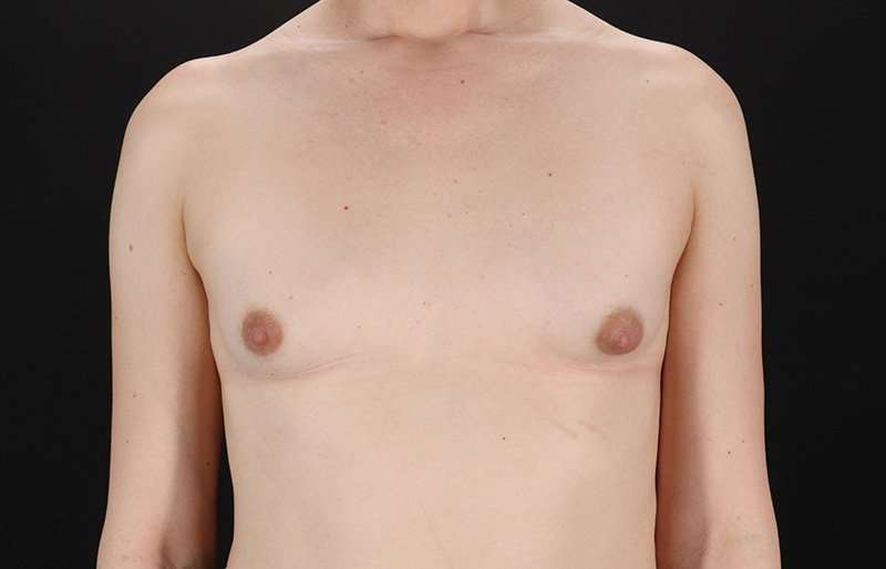 Male To Female Breast Before & After Patient #3933