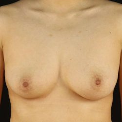 Female To Male Breast Before & After Patient #3944