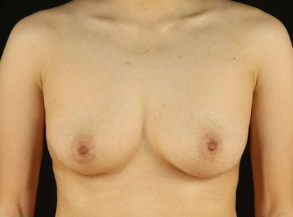 Female To Male Breast Before & After Patient #3944