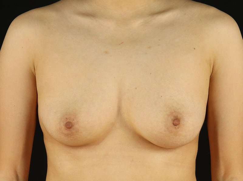 Female To Male Breast Before & After Patient #3944