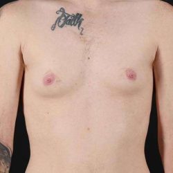 Female To Male Breast Before & After Patient #3955