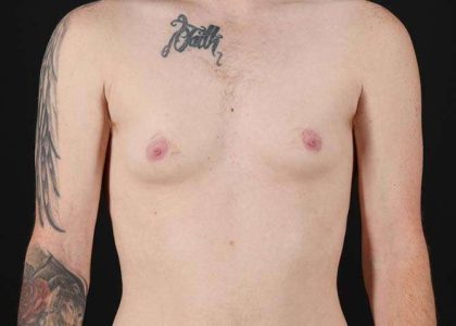 Female To Male Breast Before & After Patient #3955
