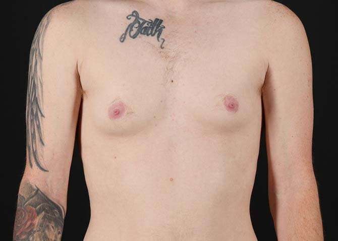 Female To Male Breast Before & After Patient #3955