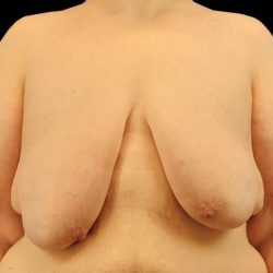 Female To Male Breast Before & After Patient #3966