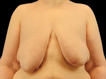Female To Male Breast Before & After Patient #3966
